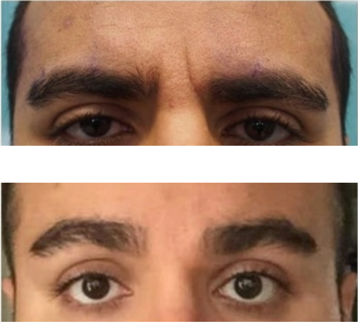 Botox Behandlung in Hanau
