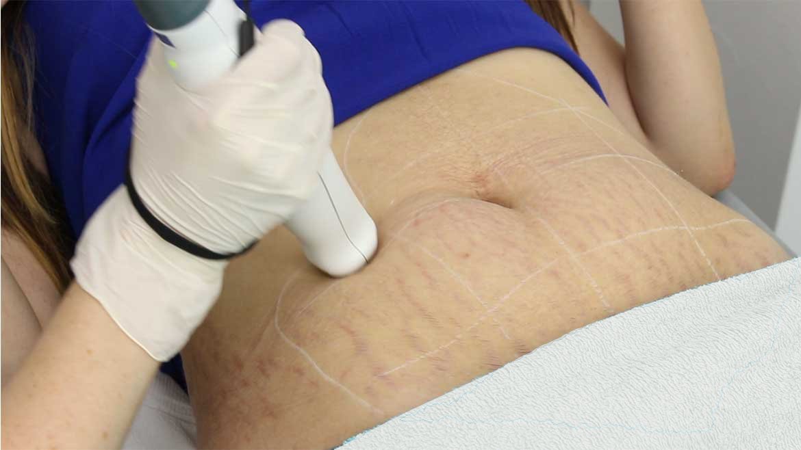 Dehnungsstreifen Behandlung mit Frax 1550 Laser in Hanau