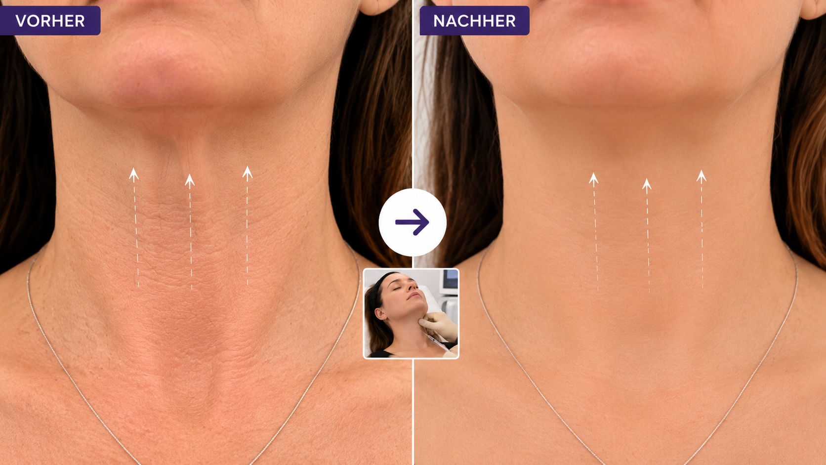 Botulinumtoxin und Platysma bei Doppelkinn