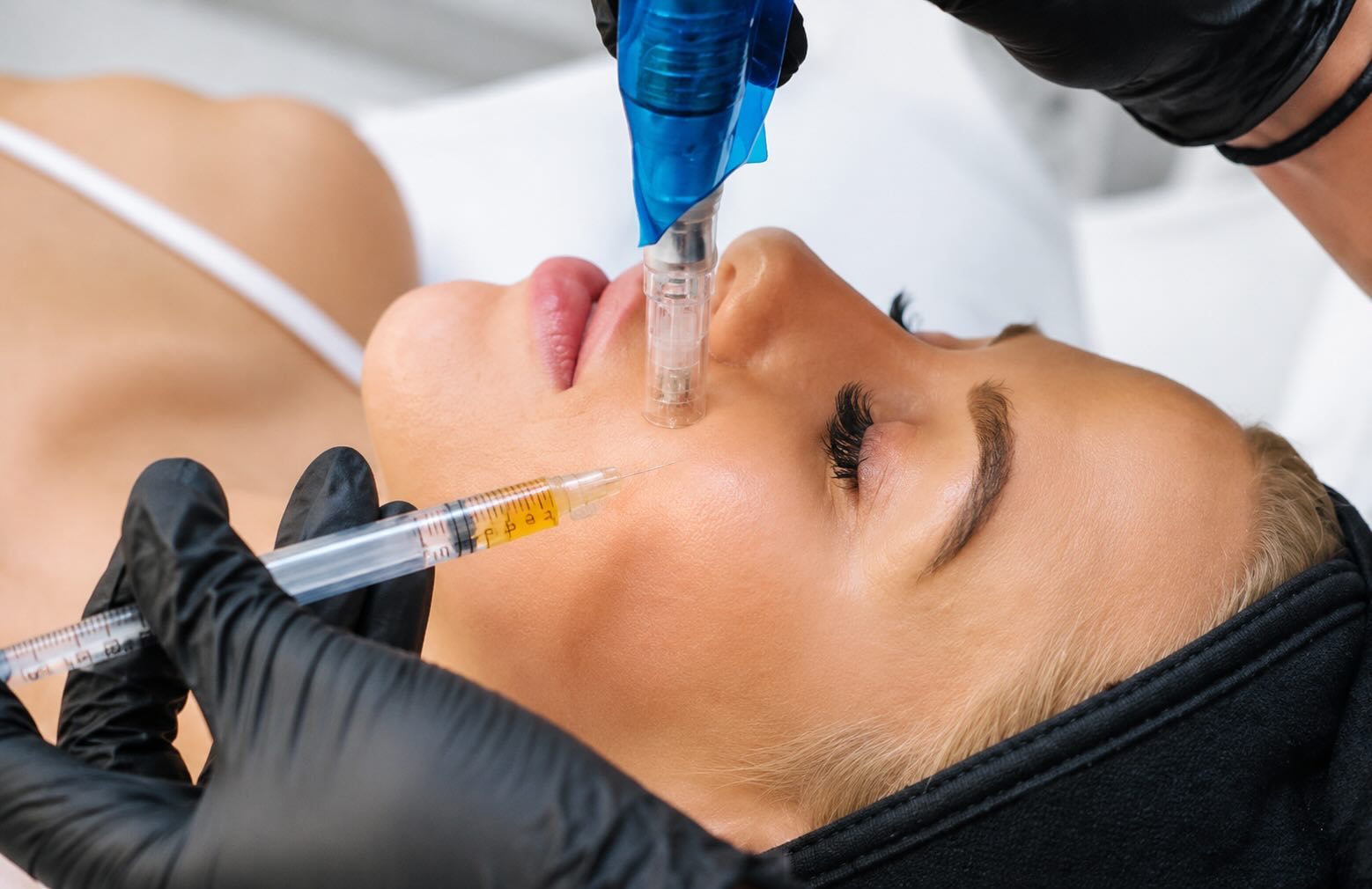 Microneedling mit PRP Behandlung in Hanau