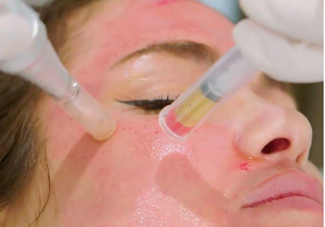 Microneedling und PRP in Kombination