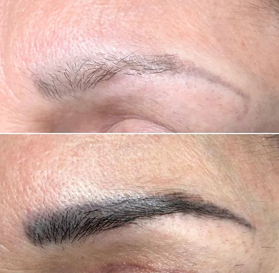 Permanent Make-up Entfernung mit Pico Laser
