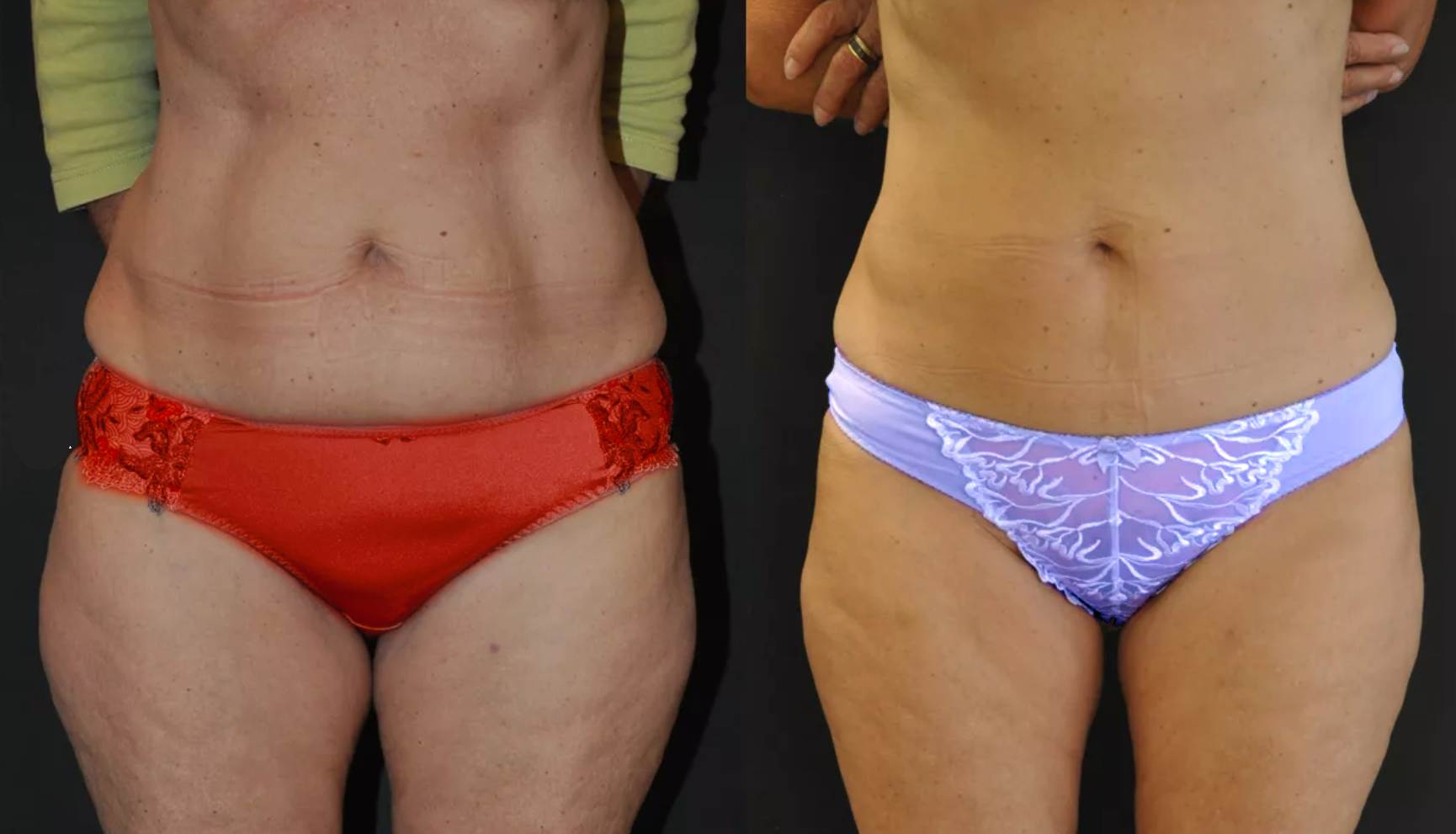 Kryolipolyse Vorher Nachher Bauch und Koerperformung Hanau