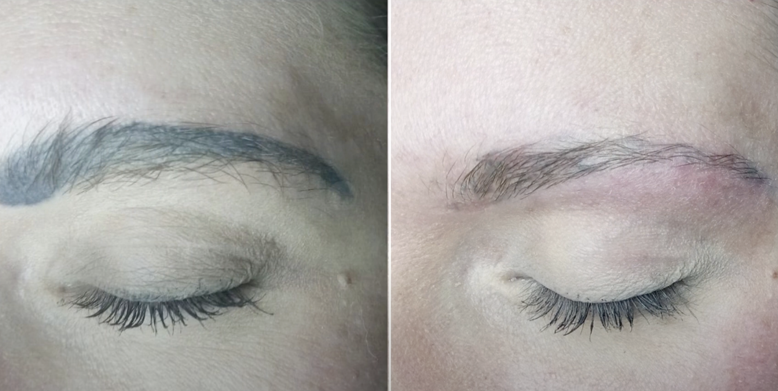 Permanent Make-up Entfernung Vorher Nachher Hanau
