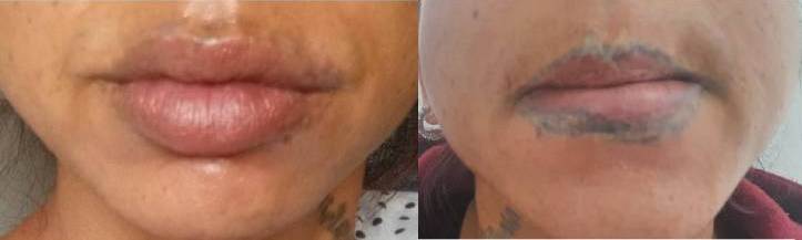 Tattooentfernung Vorher Nachher Pico Laser Hanau