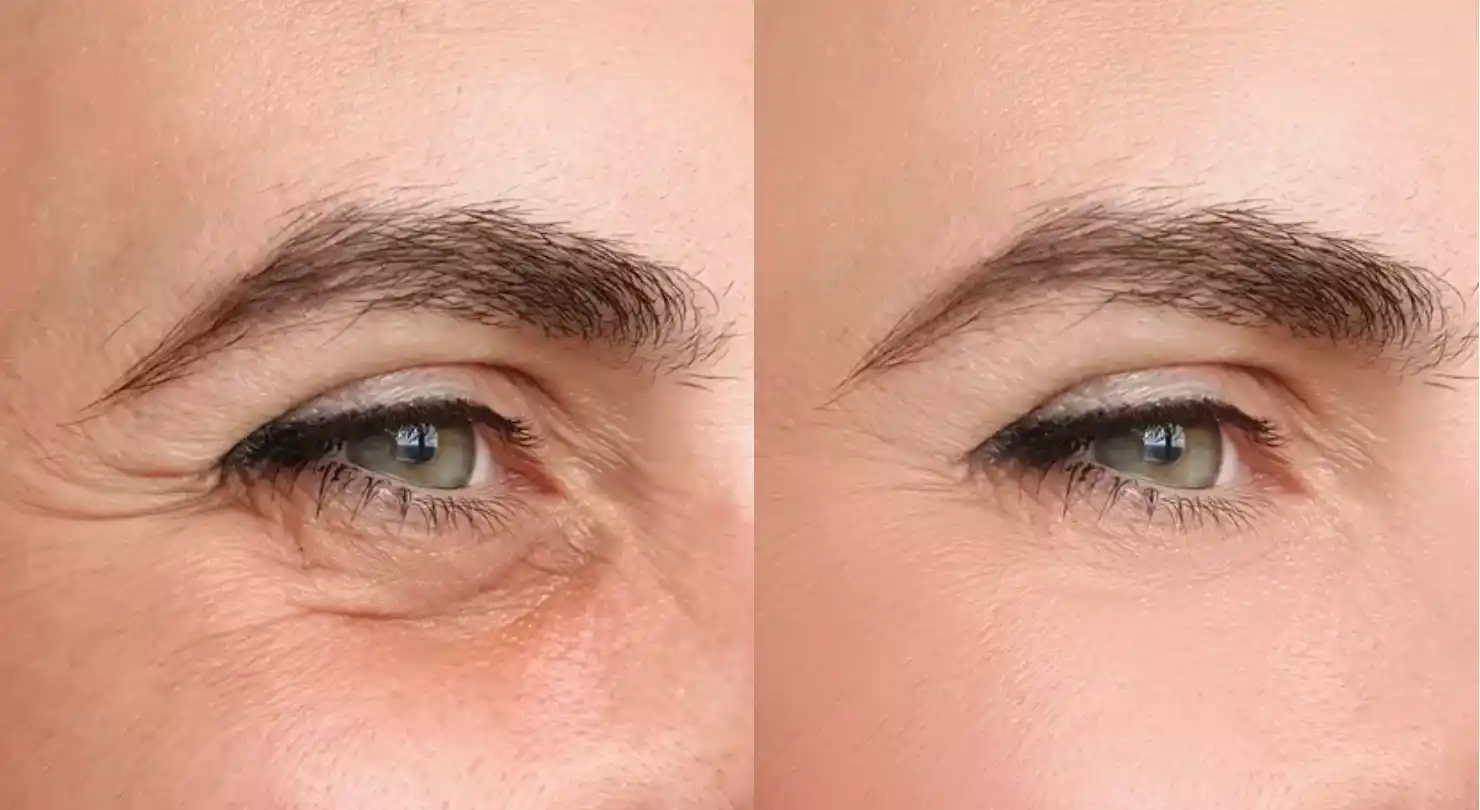 Natuerliche Resultate mit Botox