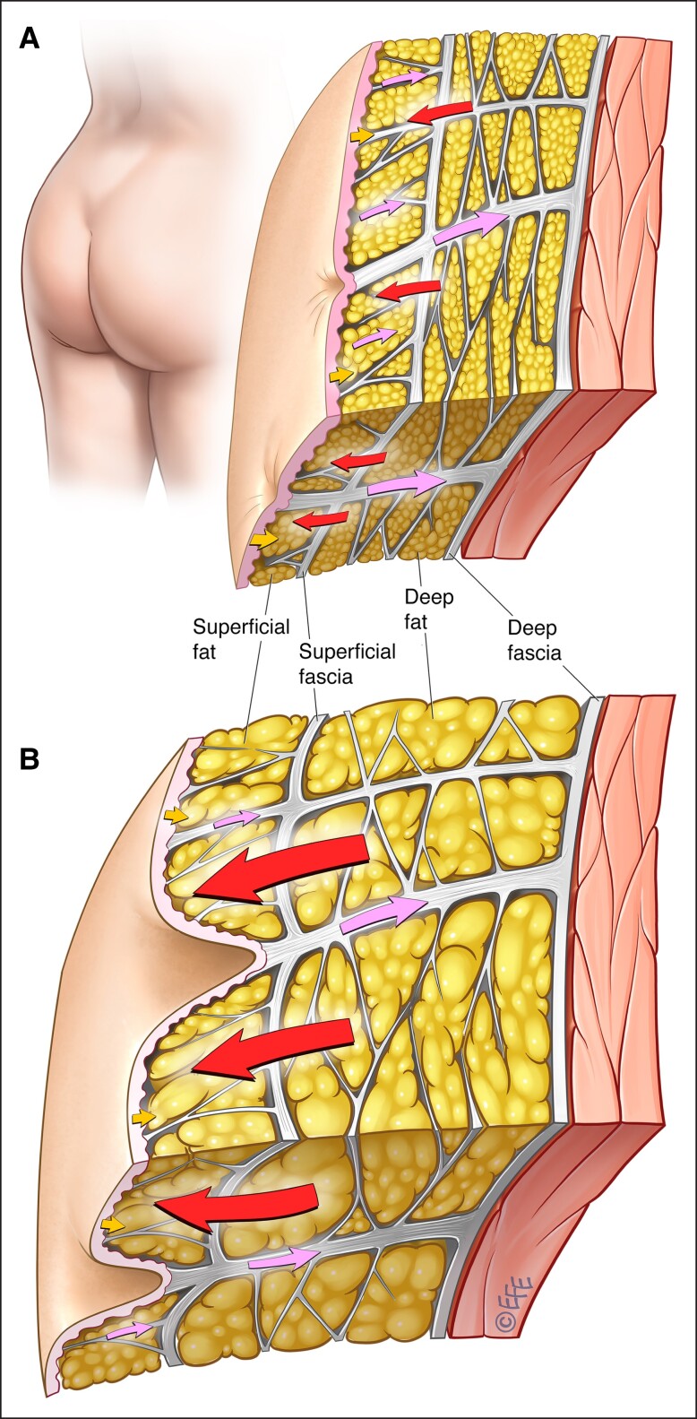 Cellulite Behandlung Hanau