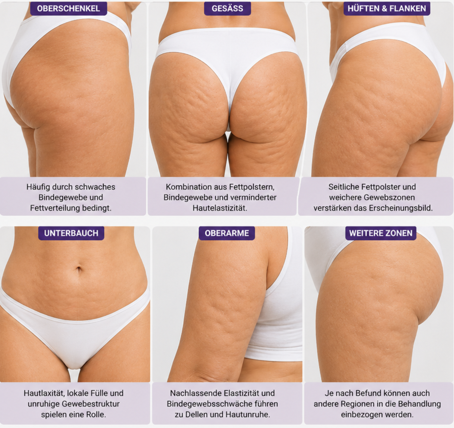 Unterschiedliche Formen und Ursachen von Cellulite