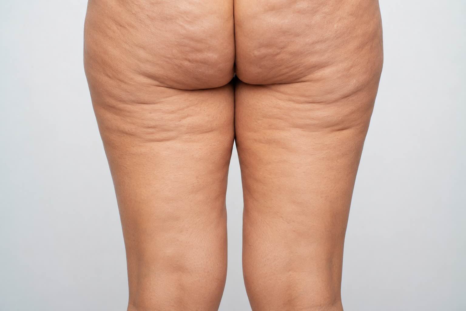 Typisches Hautbild bei Cellulite