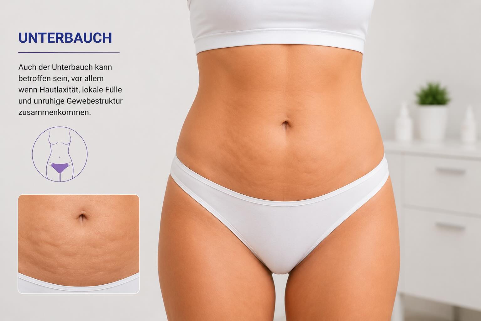 Unterbauch als typische Region für Cellulite