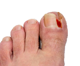 Debridement und mechanische Entlastung