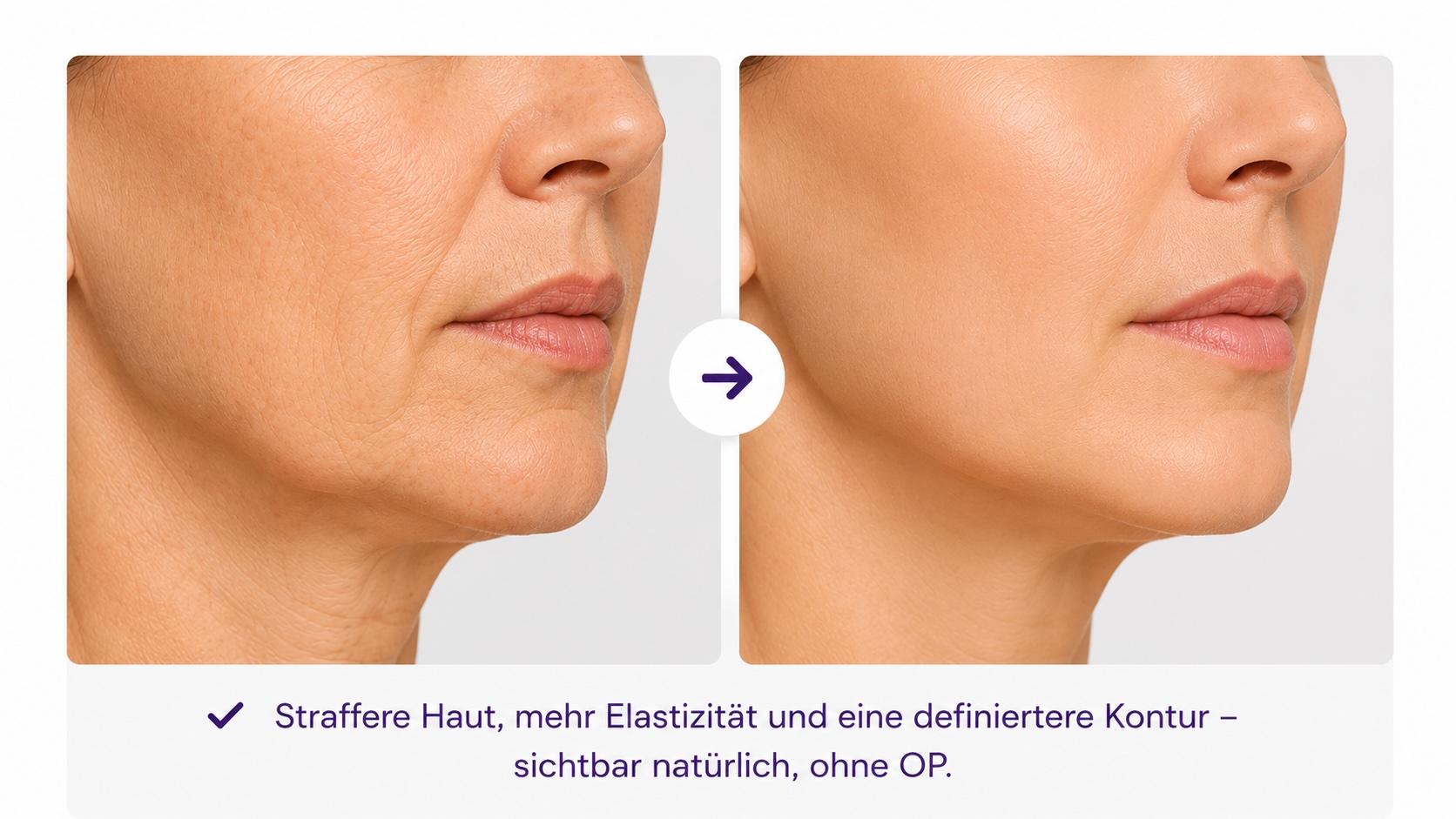Hautstraffung und Elastizitaet mit Profound Matrix