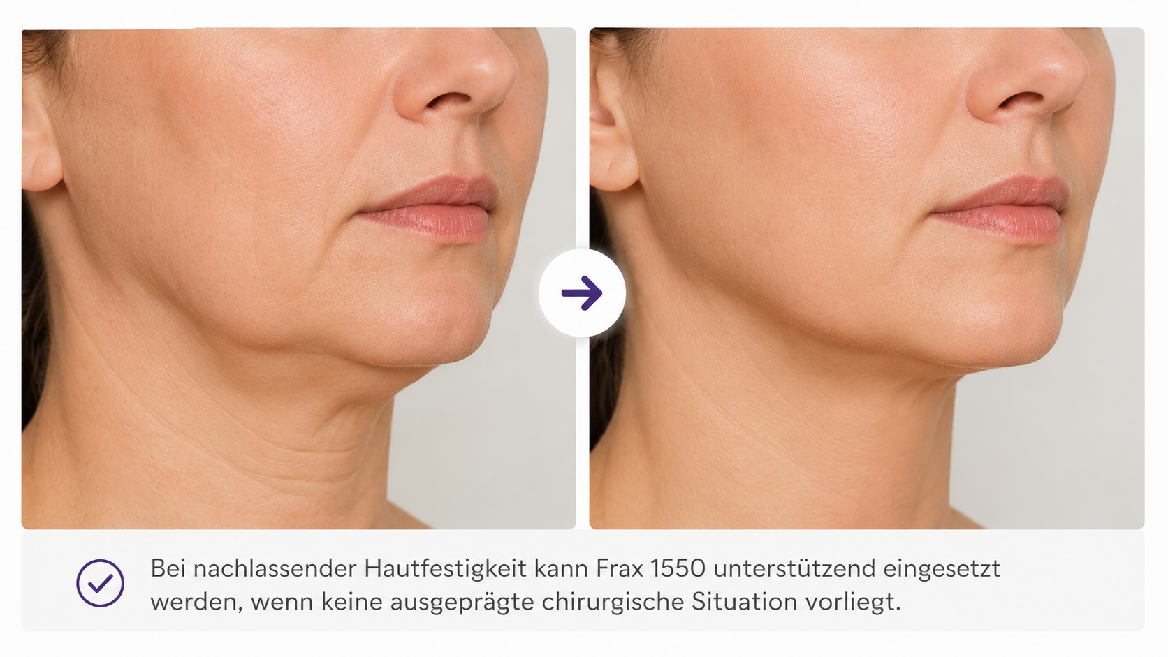 Beginnende Hauterschlaffung im Gesicht mit Frax 1550 Laser in Hanau