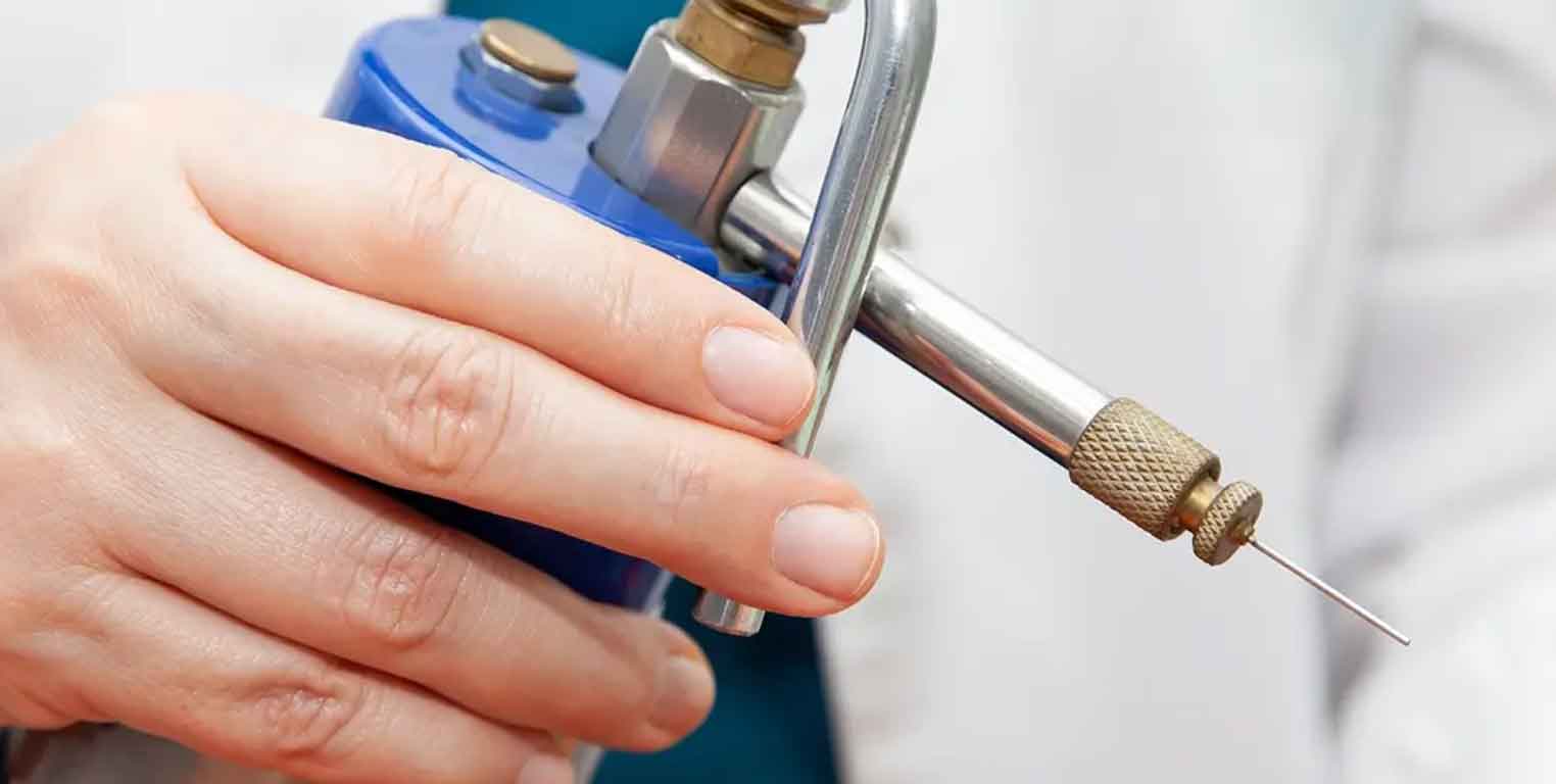 Kryotherapie bei Altersflecken
