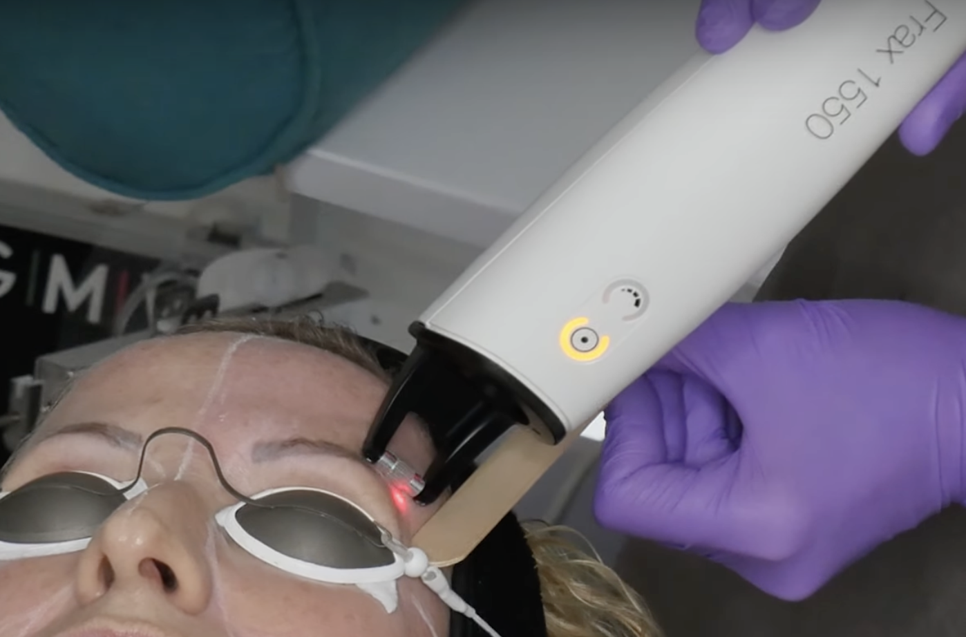 Hautverjuengung mit Frax 1550 Laser in Hanau