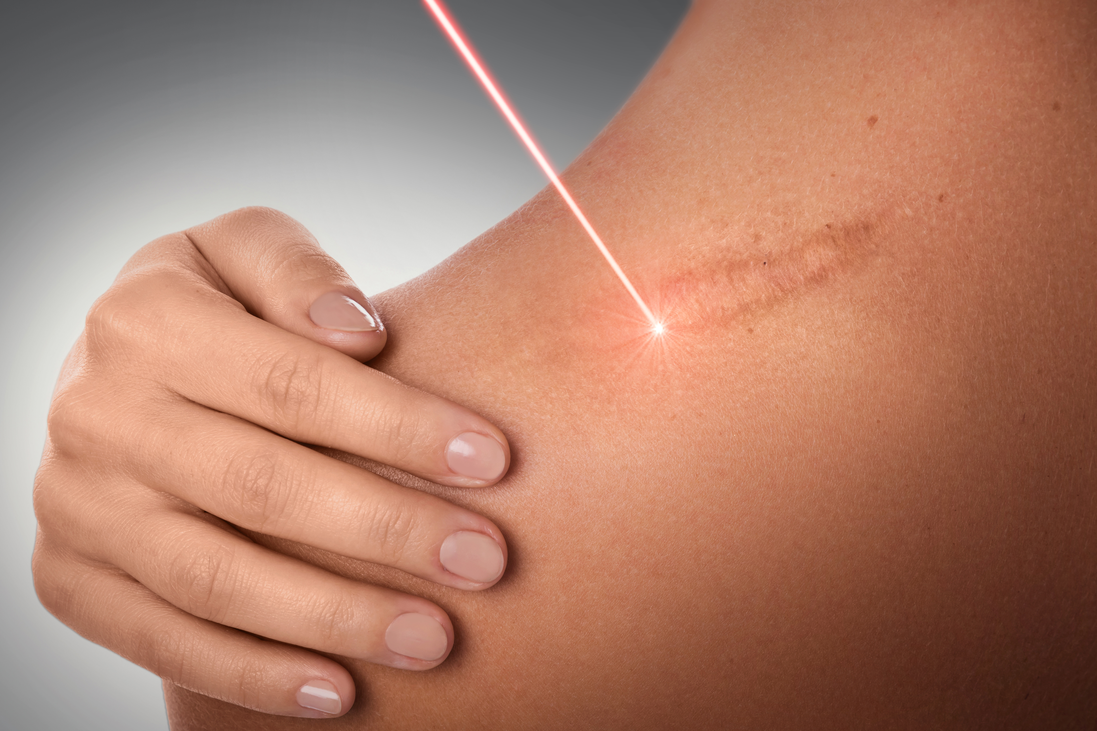 Narbenkorrektur mit CO2 Laser