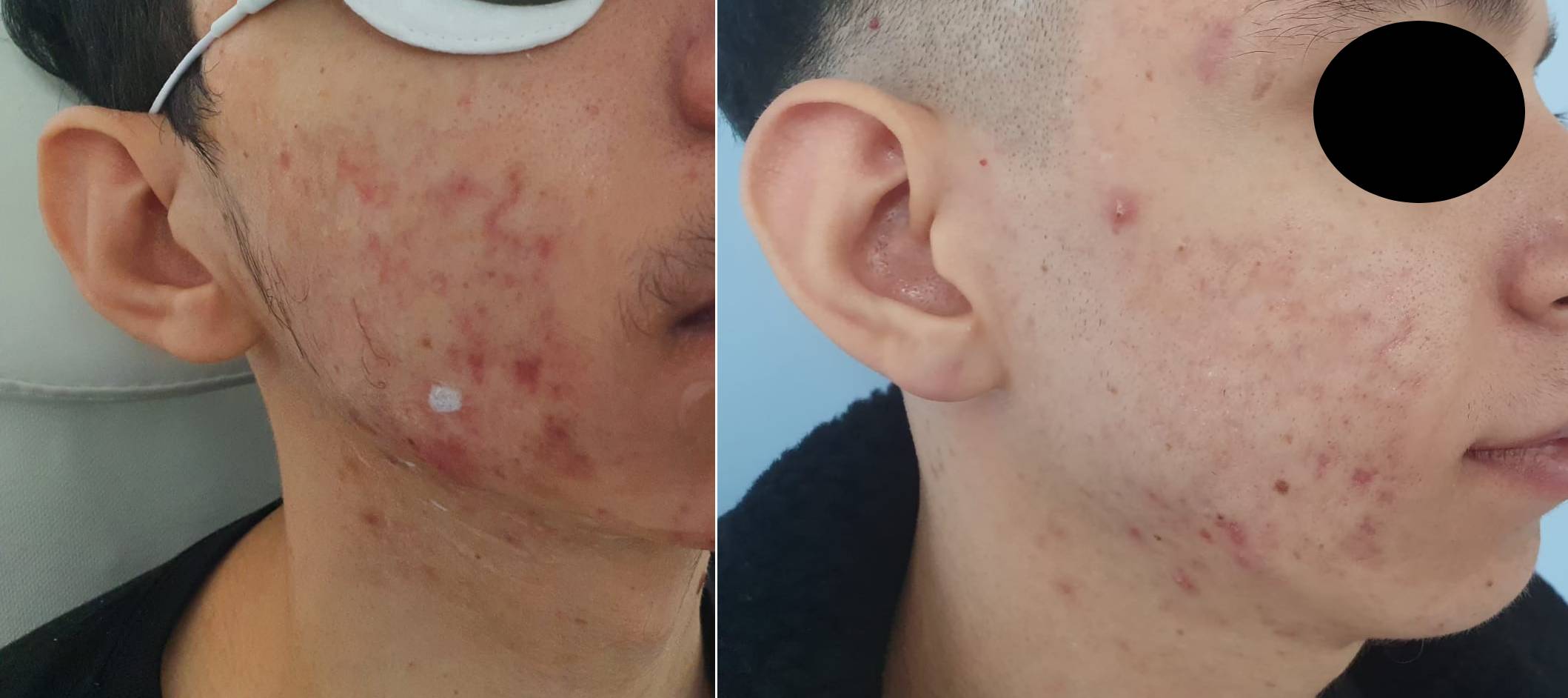 Akne Behandlung Vorher Nachher in Hanau