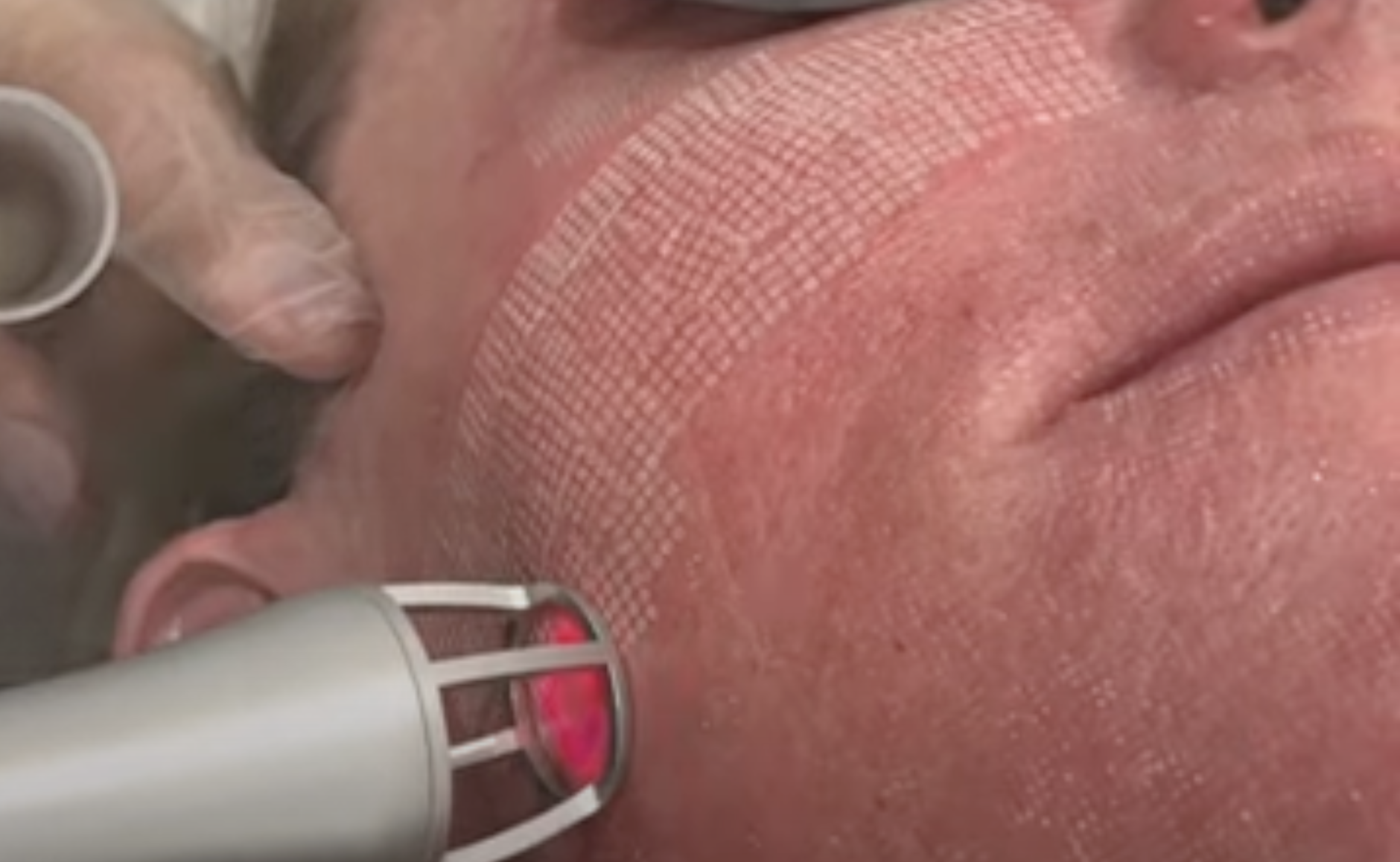 Fraktioniertes CO2 Laser Resurfacing in Hanau