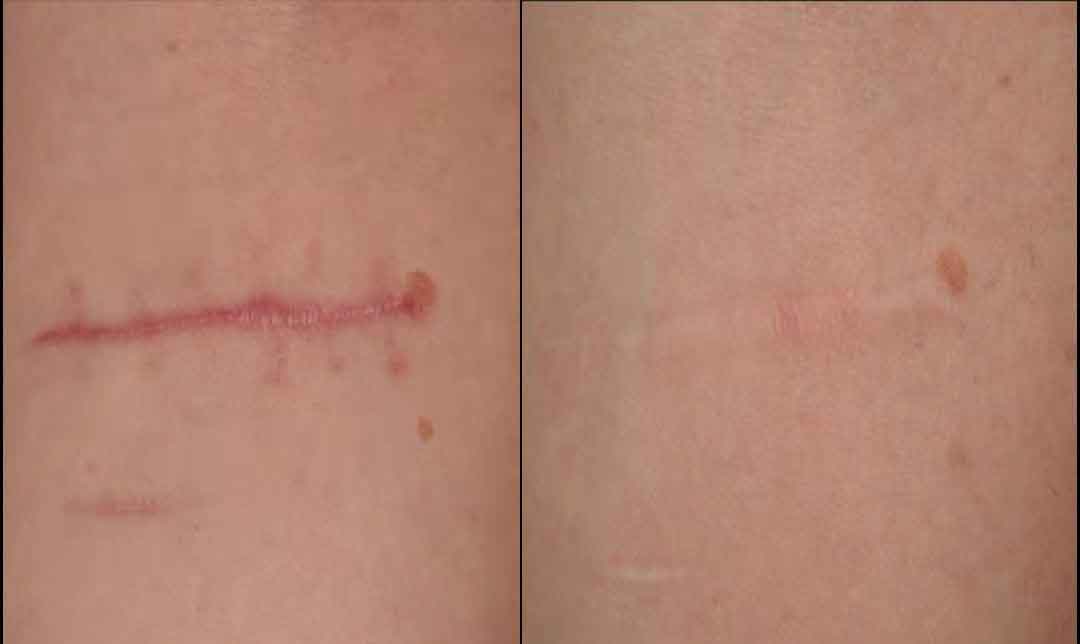 Frax 1550 Narbenbehandlung