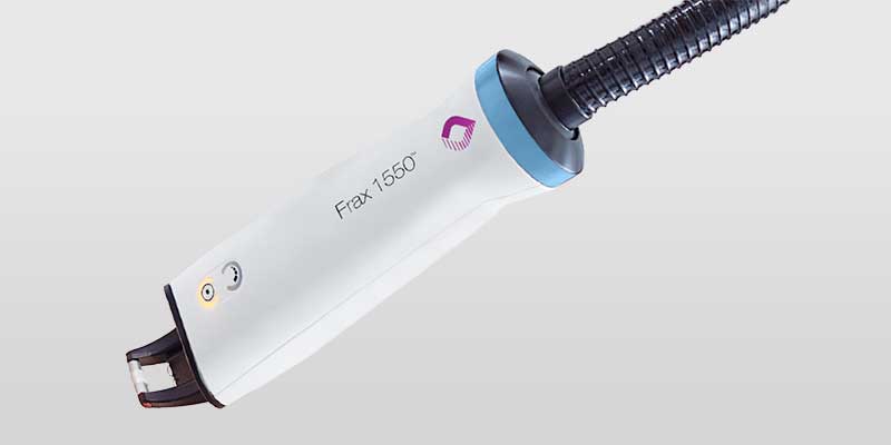 Frax 1550 Handstueck für fraktionierte Laserbehandlung in Hanau