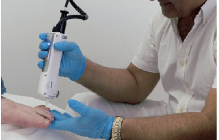 Laserbehandlung bei Onychomykose
