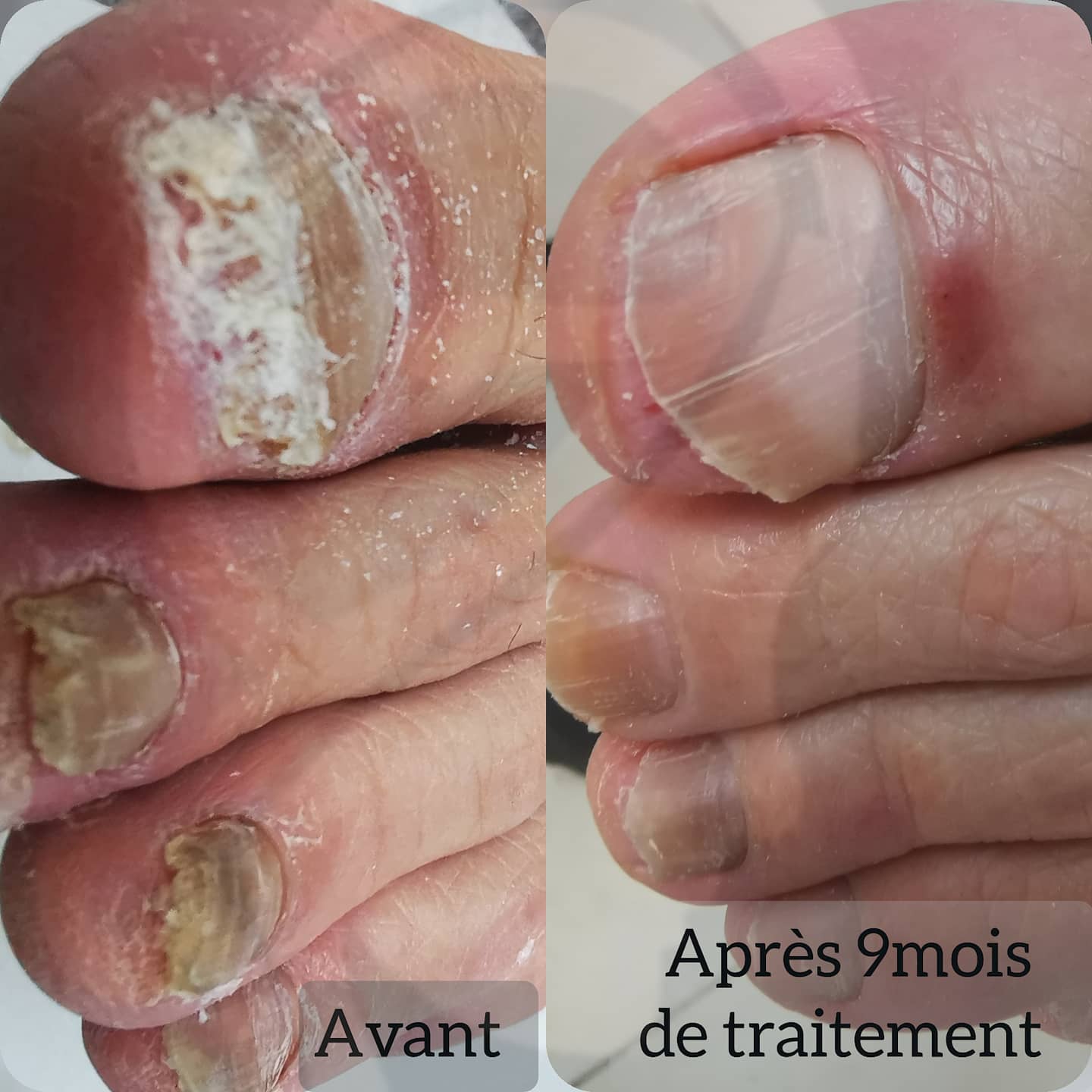 Nagelpilz Vorher Nachher Behandlung Hanau
