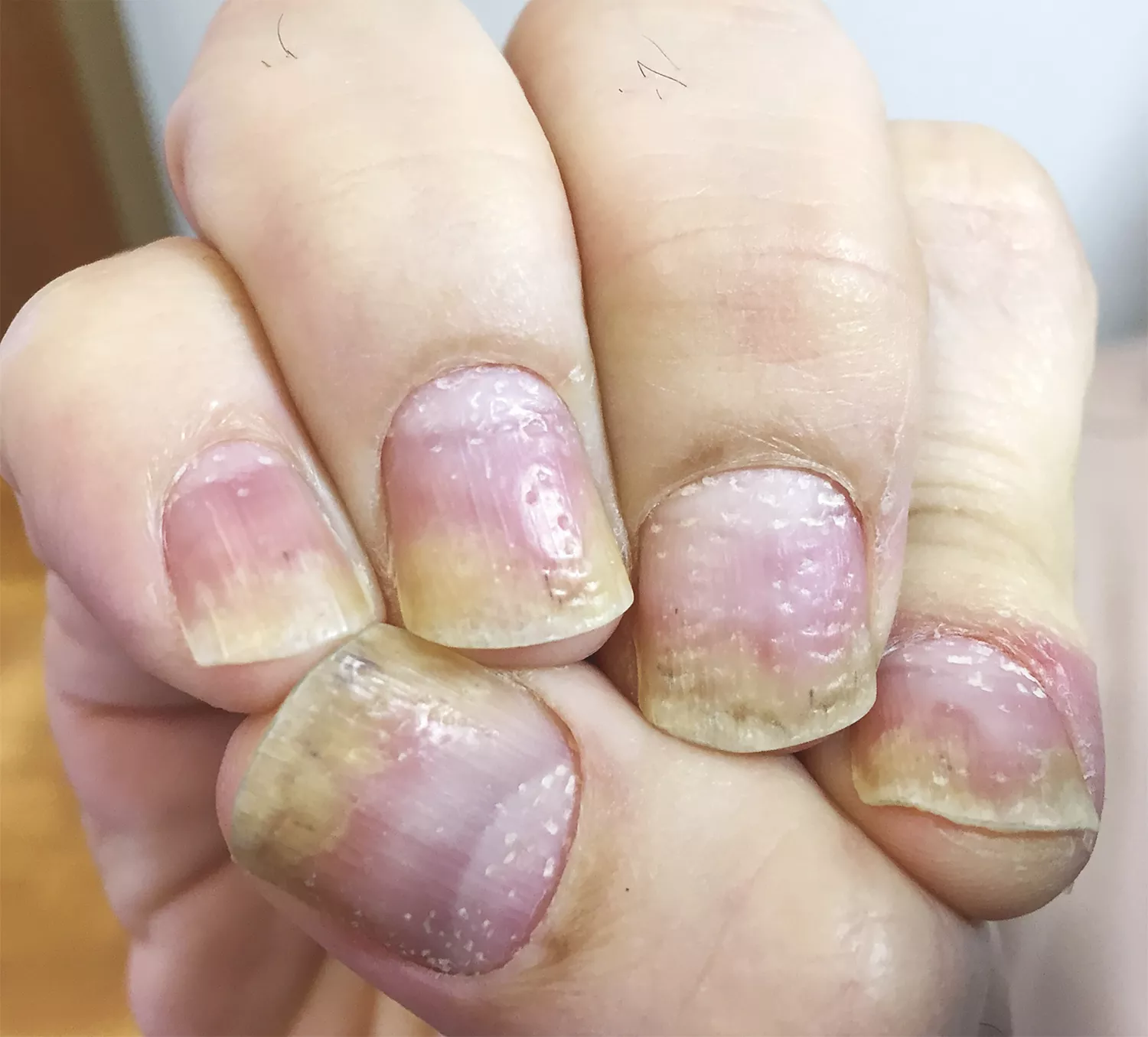 Behandlung entzuendlicher Nagelerkrankungen