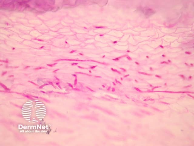 Nagelbiopsie und histopathologische Untersuchung