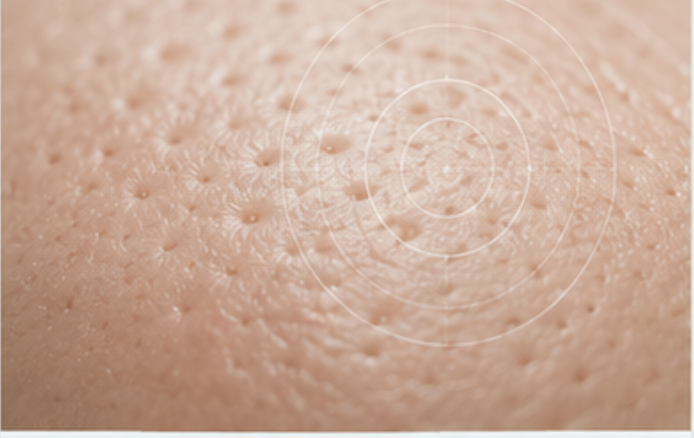 Poren und Textur bei Microneedling PRP