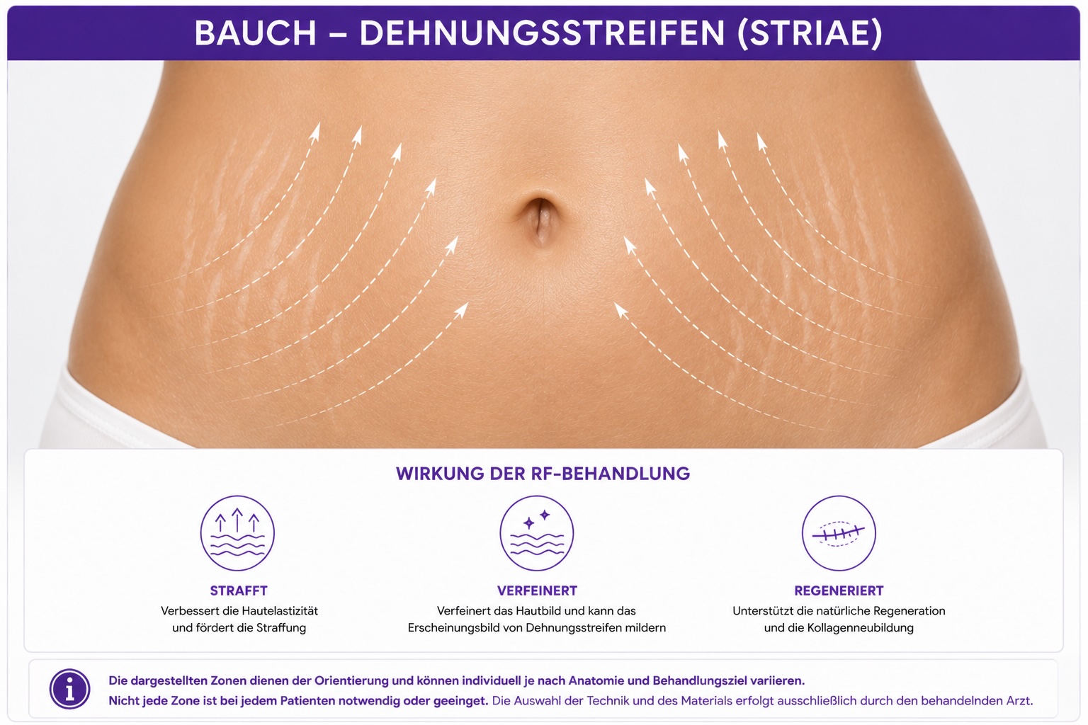 Radiofrequenz und Profound Matrix bei Narben und Striae