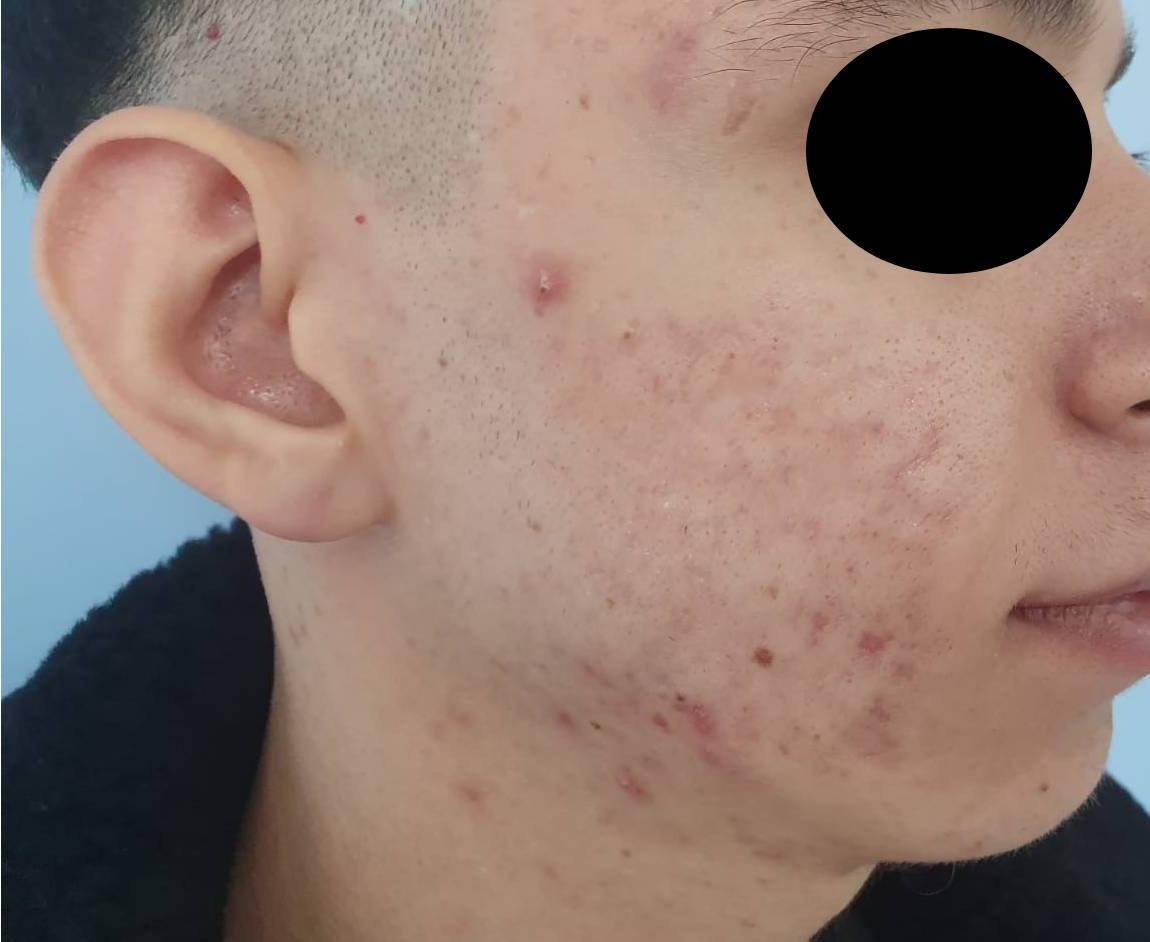 Nachher Aknenarben Laser Hanau