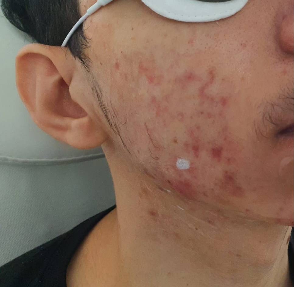 Vorher Aknenarben Laser Hanau