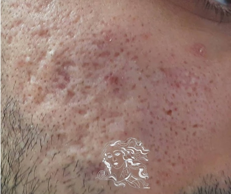 Nachher Aknenarben Laser Hanau