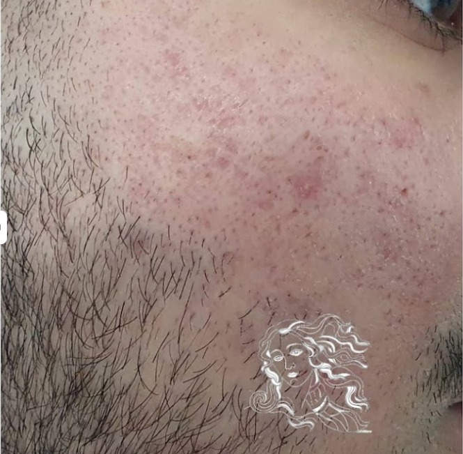 Vorher Aknenarben Laser Hanau