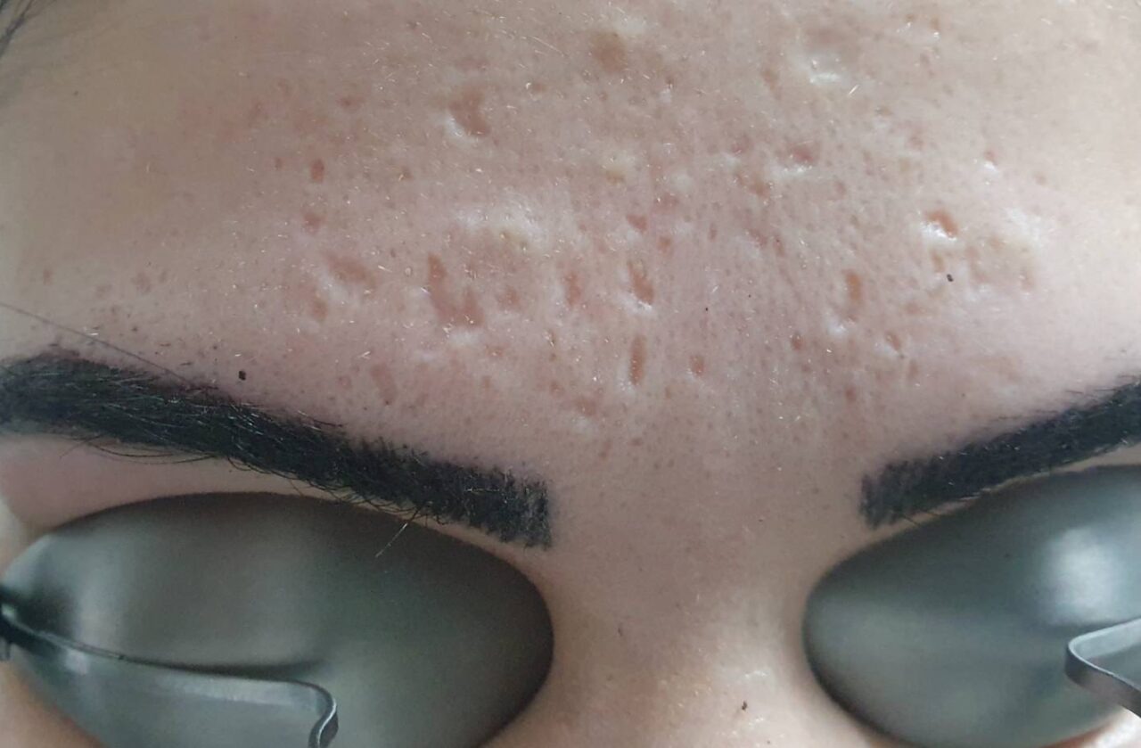 Nachher Aknenarben Laser Hanau