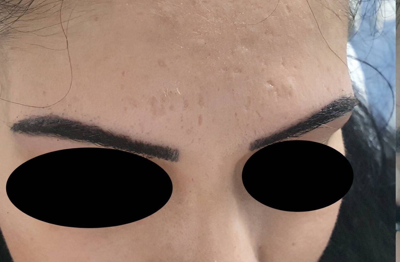 Vorher Aknenarben Laser Hanau