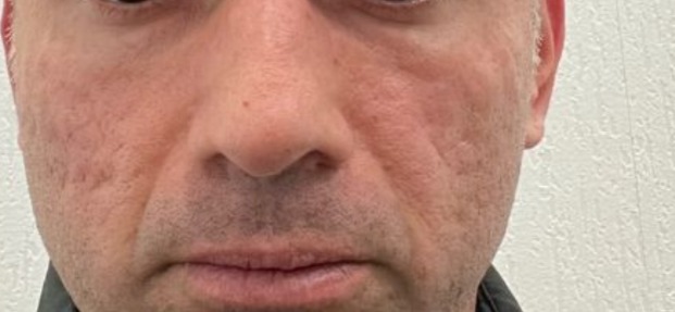 Vorher Aknenarben Laser Hanau