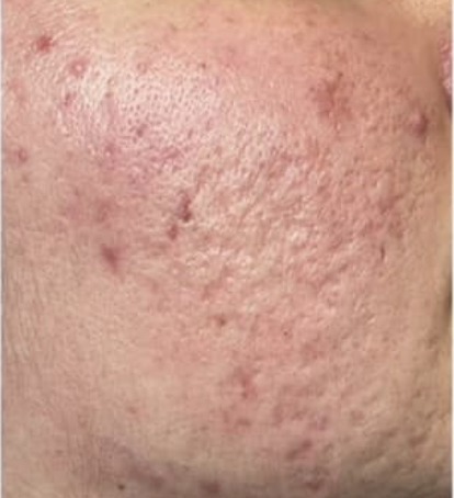 Vorher Aknenarben Laser Hanau