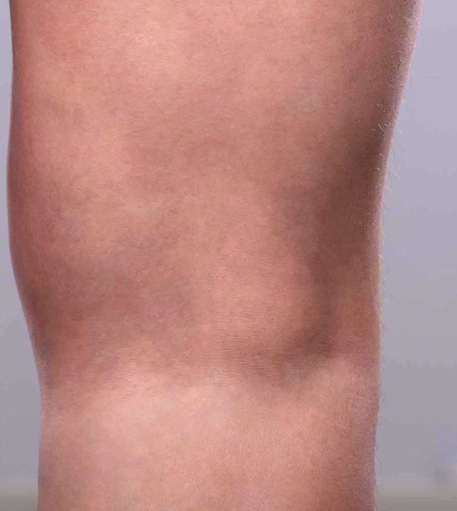 Nachher Besenreiser Behandlung mit Nd YAG Laser in Hanau