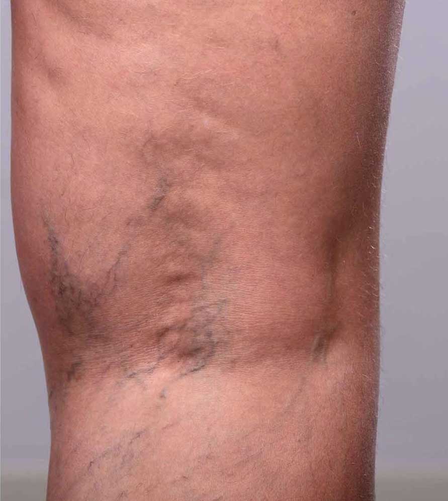 Vorher Besenreiser Behandlung mit Nd YAG Laser in Hanau