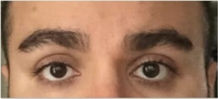 Nachher Botox Behandlung Gesicht in Hanau