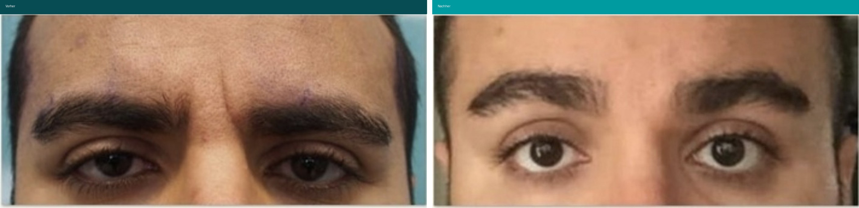Botox Vorher Nachher Hanau