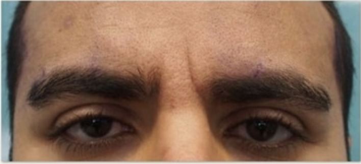 Vorher Botox Behandlung Gesicht in Hanau