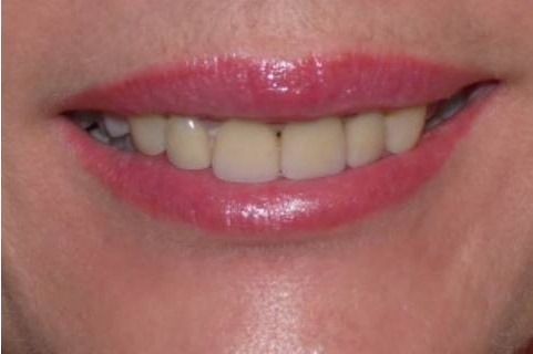 Nachher Gummy Smile Botox Behandlung in Hanau