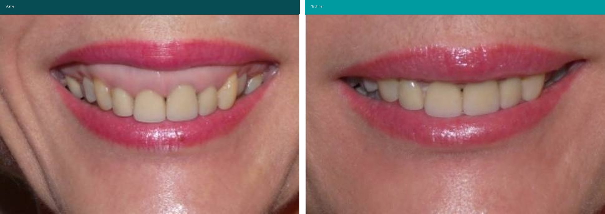 Botox Vorher Nachher Hanau