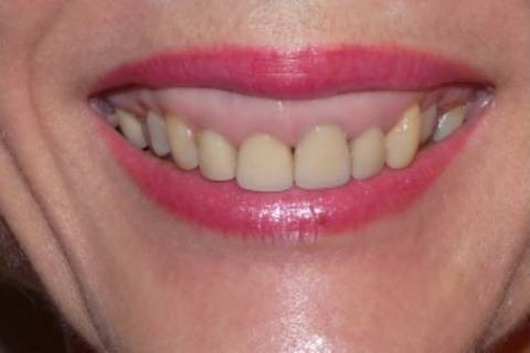 Vorher Gummy Smile Botox Behandlung in Hanau