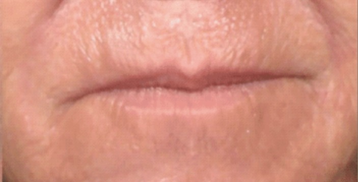 Nachher Mundfalten Botox Behandlung in Hanau