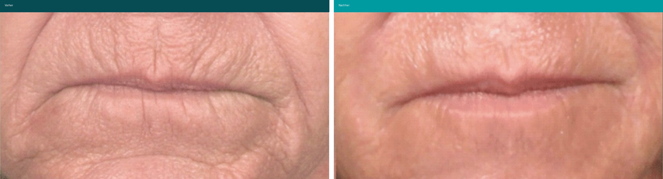 Botox Vorher Nachher Hanau