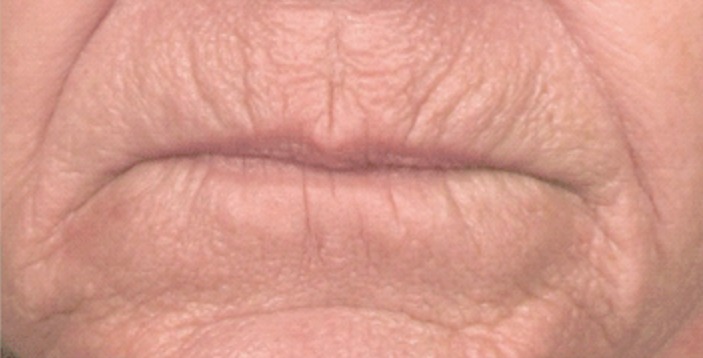 Vorher Mundfalten Botox Behandlung in Hanau