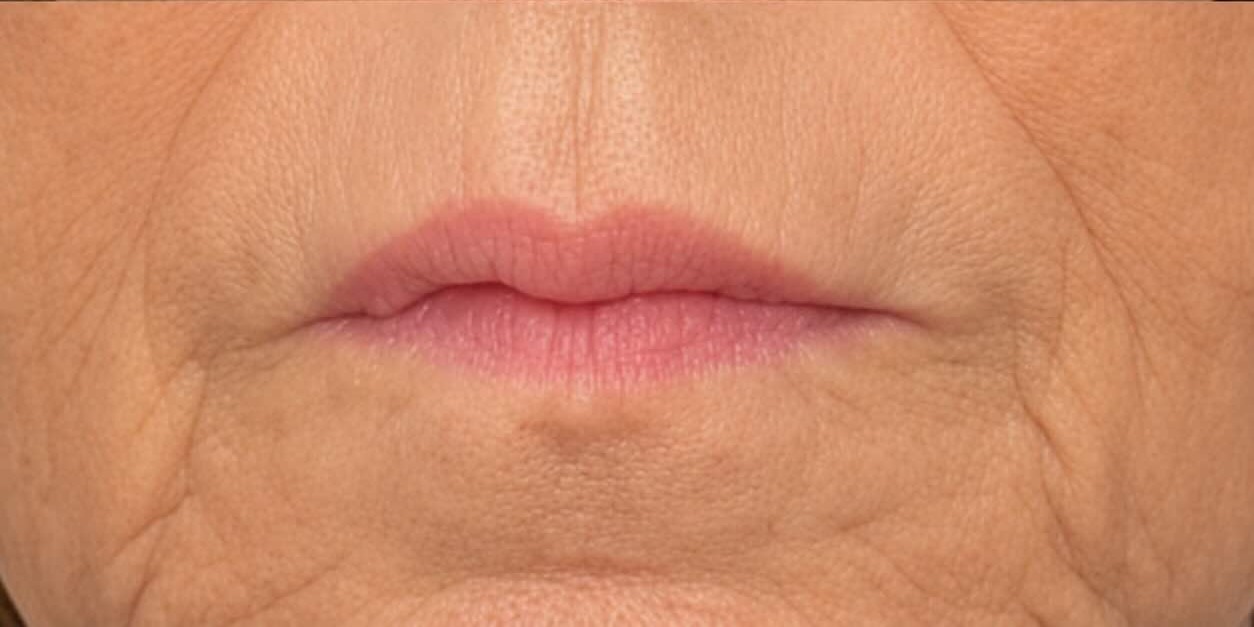 Nachher Botox Mundregion und feine Falten in Hanau